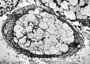 F, 75y. | skin metastasis of mucinous adenocarcinoma